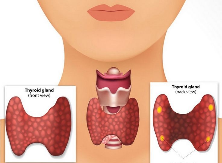 dietician in Bangalore for thyroid